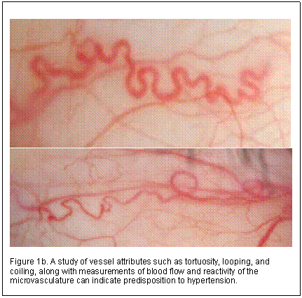 Text Box:  
 

Figure 1b. A study of vessel attributes such as tortuosity, looping, and coiling, along with measurements of blood flow and reactivity of the microvasculature can indicate predisposition to hypertension.


